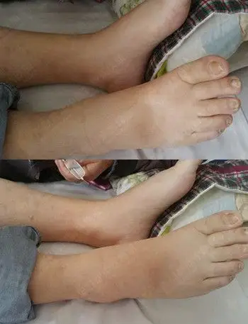 青岛静康中医肾病医院如何治疗慢性肾衰竭