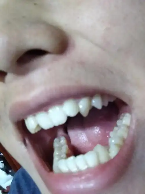 牙齿尖尖的还不整齐