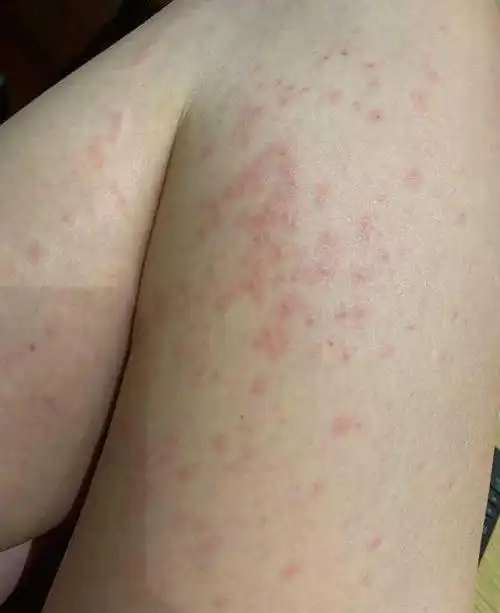 陈乔恩全身起红疹,微博晒照求安慰,反倒引来粉丝指责不穿秋裤