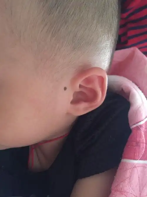 请问小孩子左边这里有痣 好吗