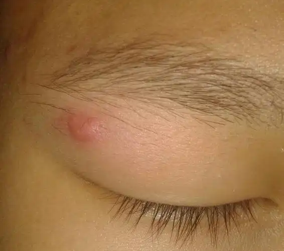 眼皮上面长了好大一颗痘痘,怎么办呀!