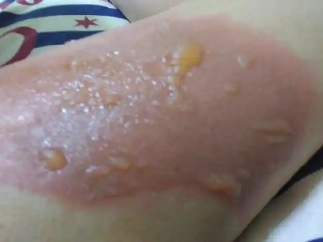 大腿被开水烫伤应该怎么处理