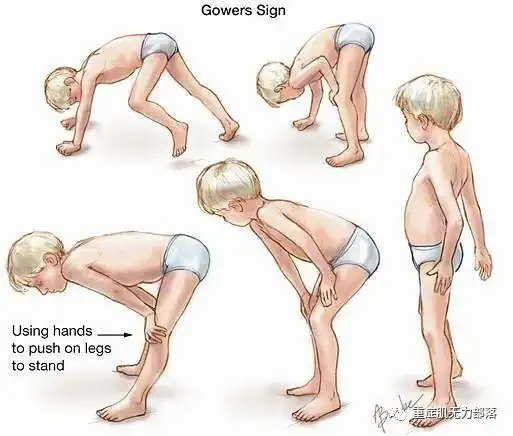 全身性重症肌无力的症状