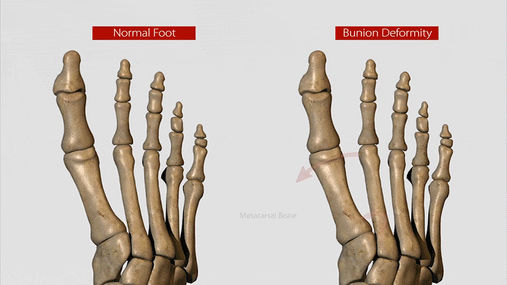 大脚骨真的是脚骨变大了吗
