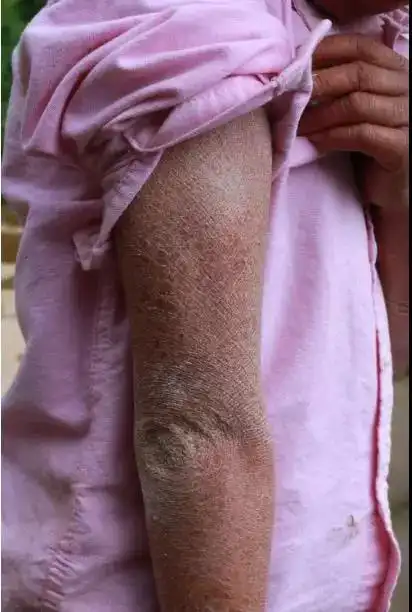 八岁鱼鳞女孩的故事腿上皮肤干燥像鱼鳞是怎么回事_腿上有很多皮屑是