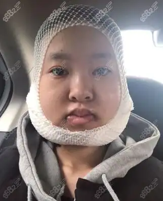 地包天长脸跑第四军医大学西京医院做正颌手术变短的经历