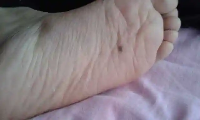 脚底有痣是什么意思,宝妈们帮我看看