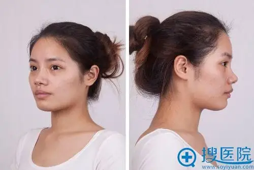 术前正面侧面照片展示