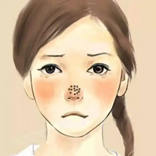 比痘痘更恐怖的黑头,到底有哪些清理方式?