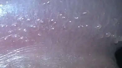 珍珠疹,又被冤枉成是性病,这个锅不能背!