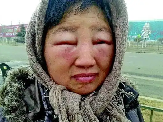 女子眼睛肿成一条缝,疑因染发过敏