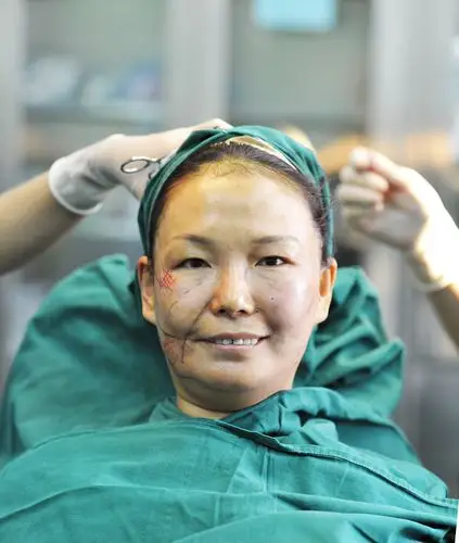 面部微雕亲身经历,带你玩转面部微雕整形术大概多少钱?