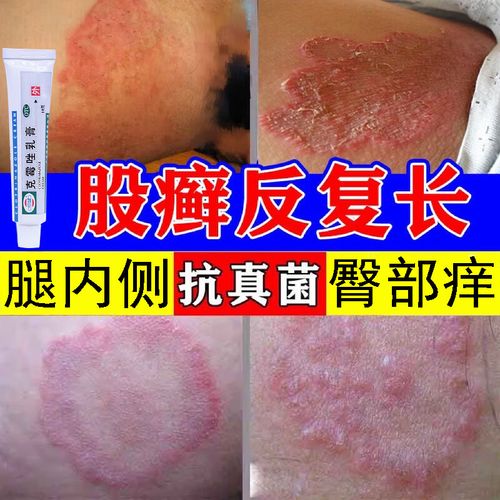 感染大腿两侧长皮癣发红股藓潮湿闷热出汗阴囊私处瘙痒红疹克霉唑软膏