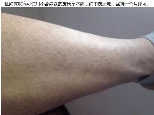 鱼鳞皮肤病早期症状 早期护理去除快