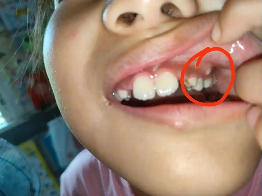 上次我拔了智齿今天去拆线了…… 喊医生给我家小朋友看了一下牙齿