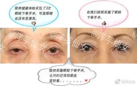 8-1 美容整形外科实施的眼睑下垂手术