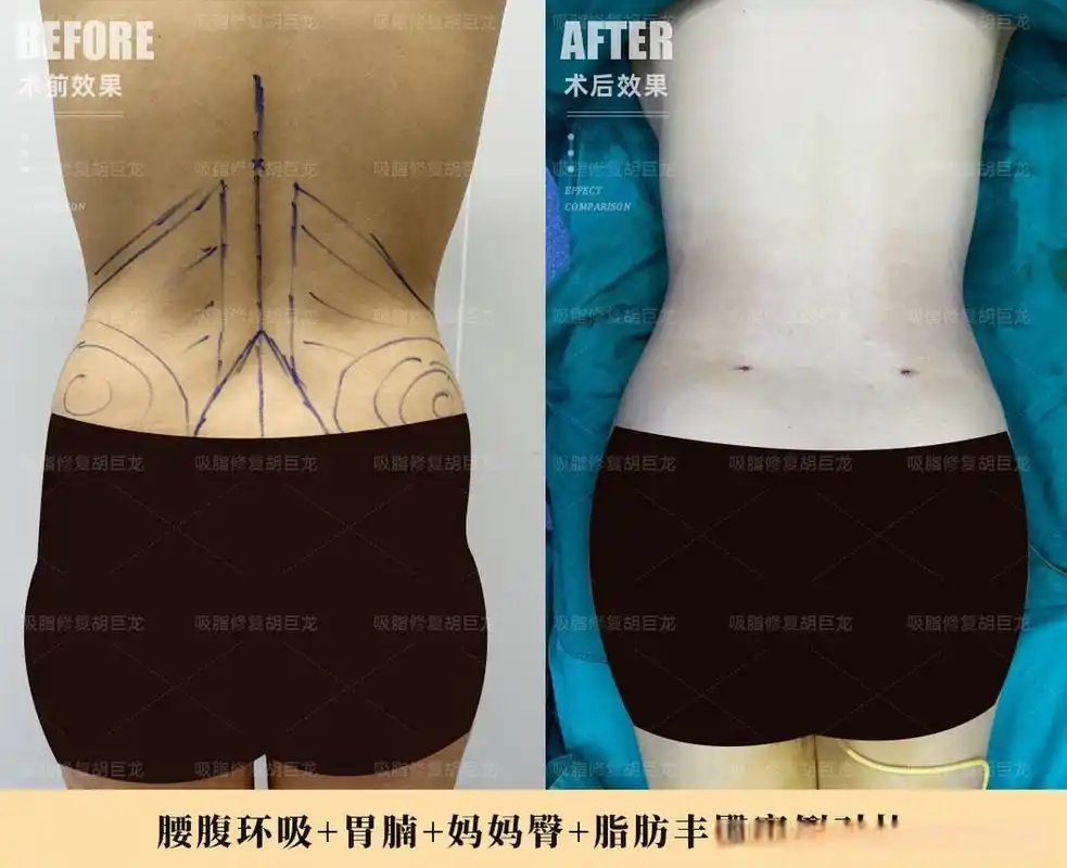 宝丽太腰腹环吸,胃腩,妈妈臀吸脂,脂肪丰臀案例对比  姑娘腰腹脂肪