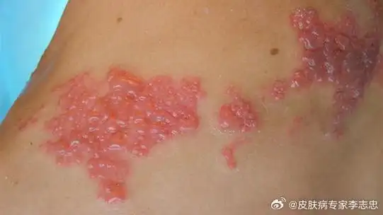 #带状疱疹#