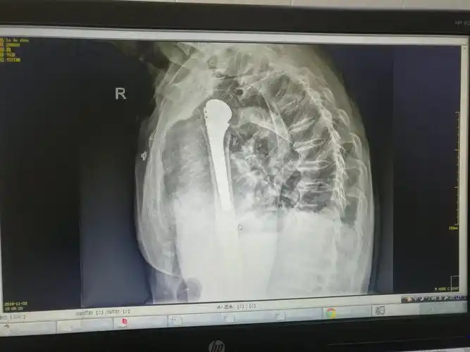 厉害,让老大爷重拾生活信心!德昌县首例人工半肩关节置换术获得成功.