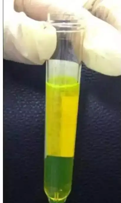 紫色尿液(图7),来自紫色尿袋感染患者,即患者长期携带尿袋而出现的一