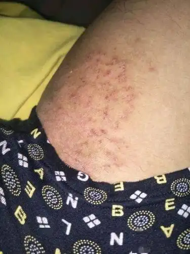 股藓症状图片湿疹和股癣有着十分相似的症状,所以容易被混淆,但随着