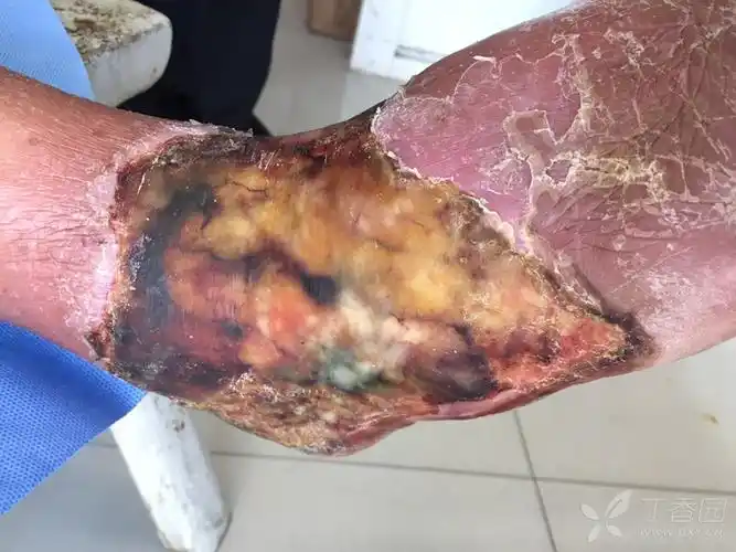 这个是什么原因?坏死?色素沉着?创面尚未愈合?谢谢! 查看 查看 查看