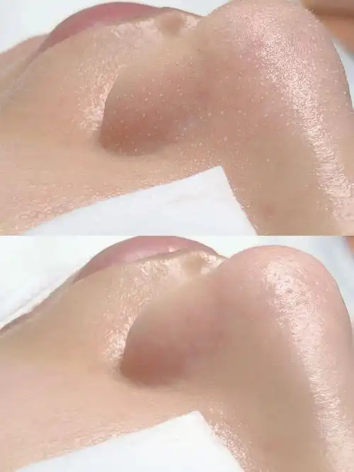 毛孔清洁的重要性