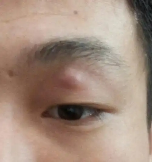 眼皮上有个痘痘.开始有个小痘痘,挤出来像虫子一样的东西.