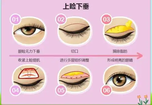 上睑下垂_上睑下垂治疗方式 - 好大夫在线