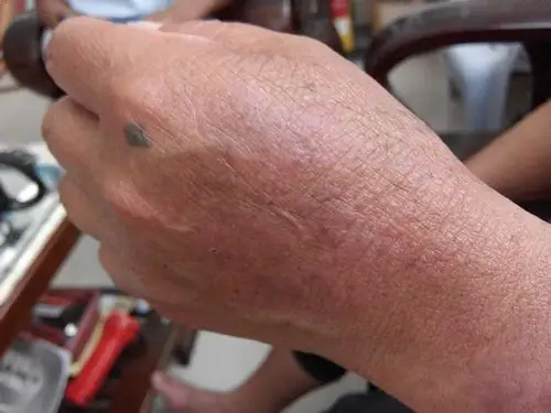 老妈手背皮肤上的死皮,有谁知道是什么,怎么治疗?