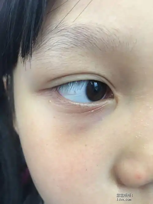 我晕,我女儿眼睛下面生脂肪粒了,难道也去挑掉?