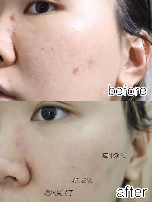 豆肌毛孔救星黄金射频微针体验分享