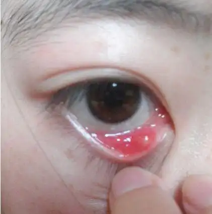 麦粒肿图片上眼皮 - 搜狗图片搜索