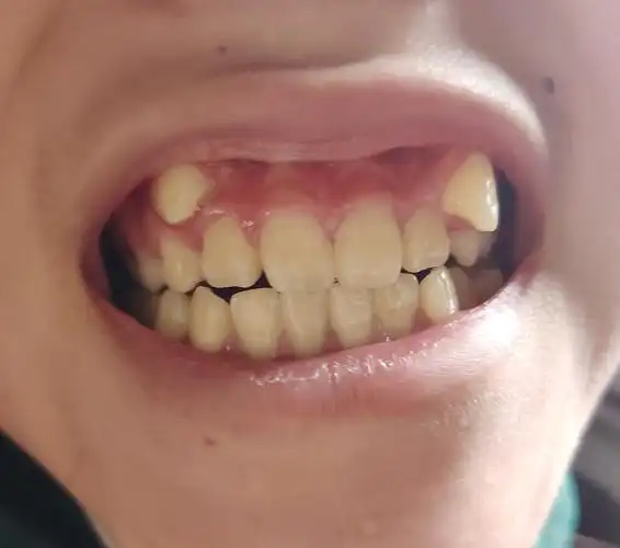 虎牙凸出好丑啊