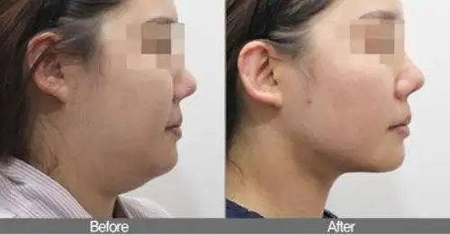 双下巴溶脂术前术后对比图