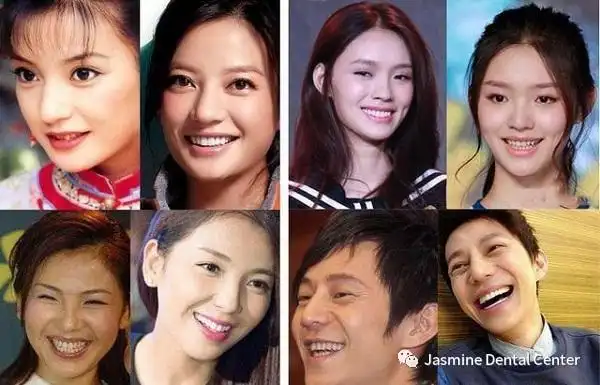 为什么这么多明星都开始整牙原来可以这样