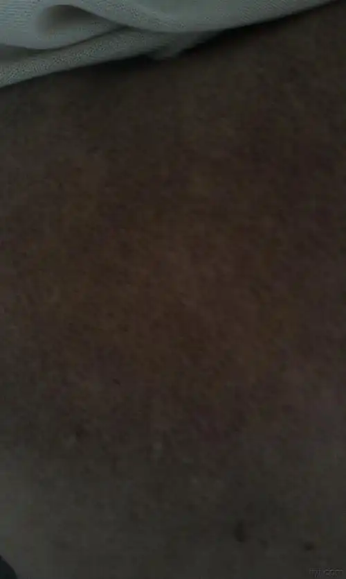 求助:背部大片黑色沉着,散在皮疹