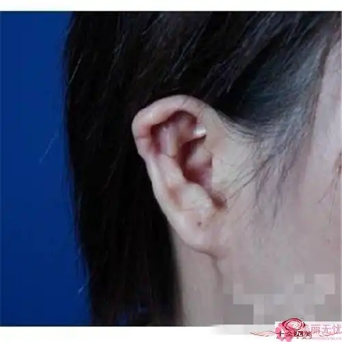 耳朵重塑的类型有哪些