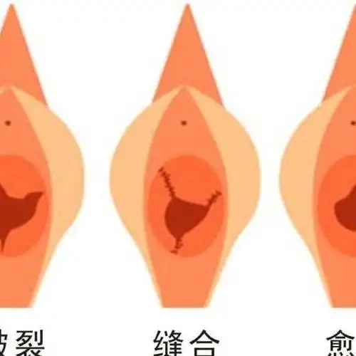 修复处膜过程视频教学_修复处膜手术费用_有人做过修复处膜