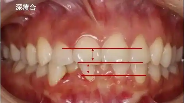 也就是说,如果 上牙包住下牙的范围超过了2~3mm,就是深覆合.