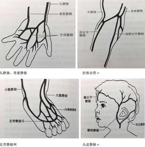 五大案例:手把手教你正确选择留置针穿刺部位