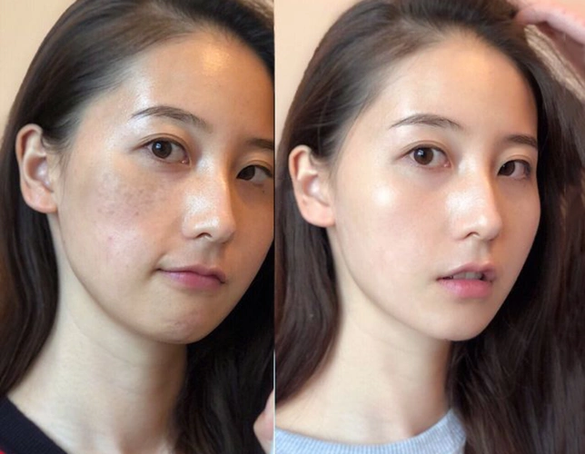 阿本紫璐美白祛斑精华液抹在肌肤上的美白针持美白祛斑特证