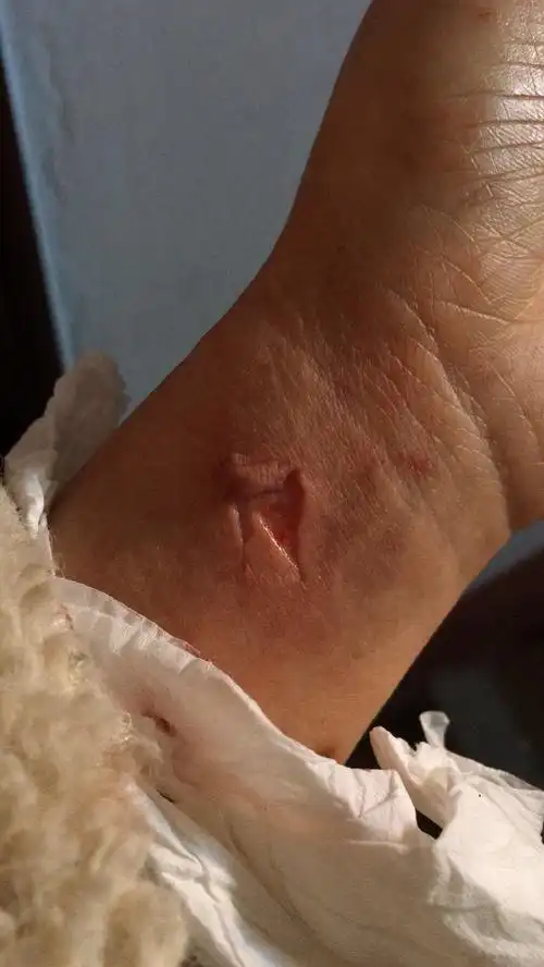 被酒瓶割伤2厘米伤口逢了8针没有打破伤针有事吗?