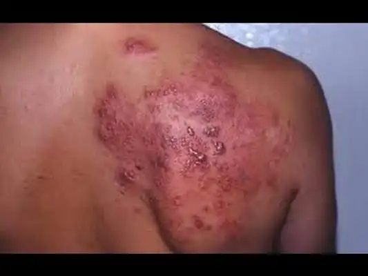 艾滋初期皮疹图片40