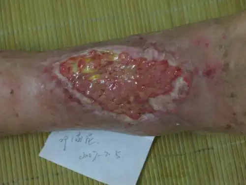 踝部绞轧伤术后一个月皮肤肌腱坏死并感染