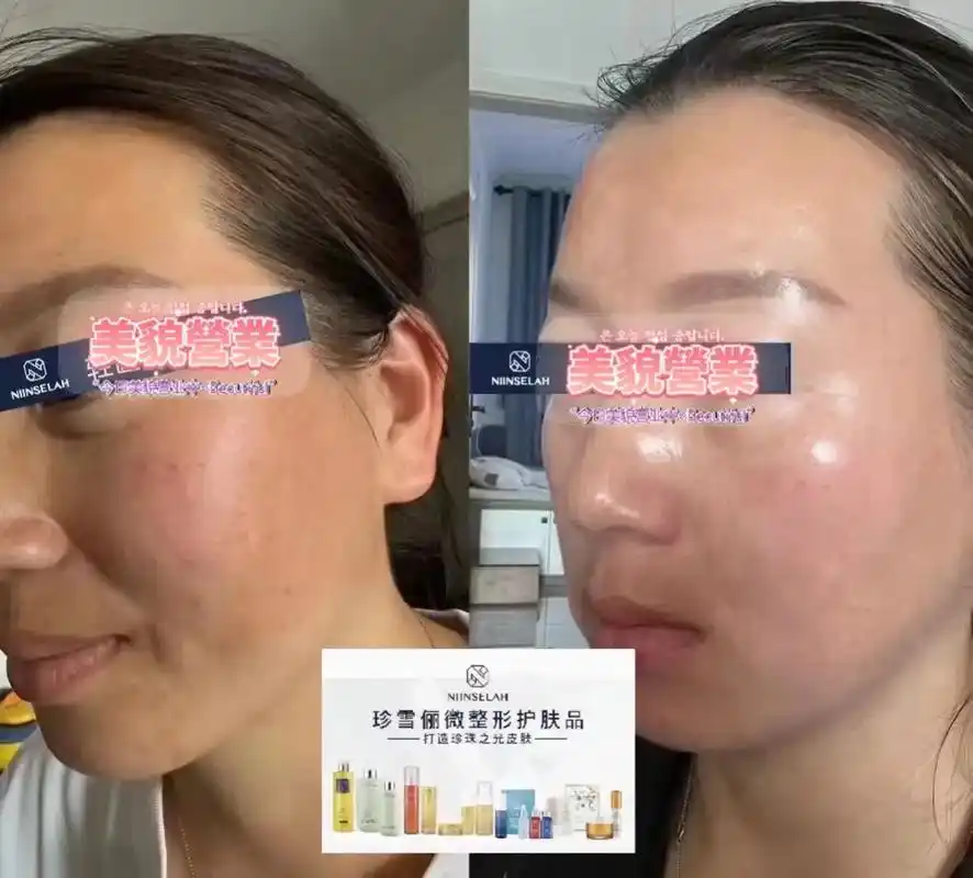 珍雪俪使用一年前后对比90改善了暗黄,皮肤更细腻紧致,法令 - 抖音