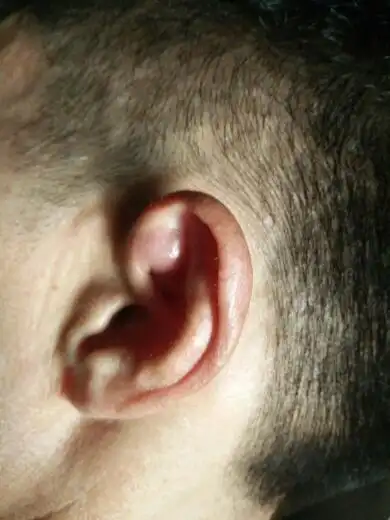 耳窝上面耳朵内侧上面一点长了个包软的,刚长出来的时候有点疼,后面就