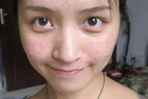 夏天长痘痘怎么办痘痘肌肤怎么调理