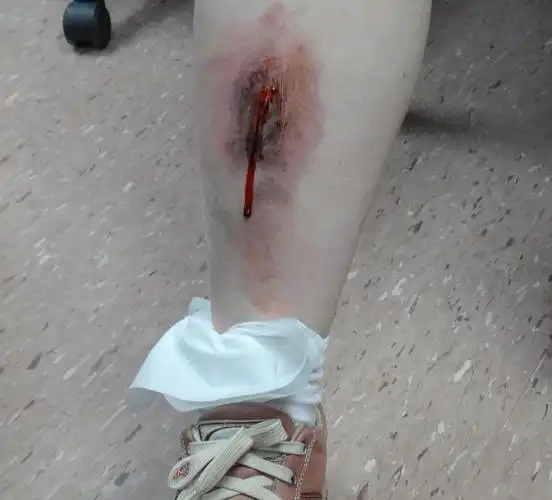 有伤口不能吃酱油喝咖啡? 医:深色疤痕的真相是.