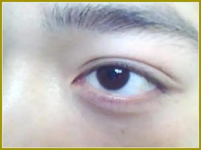 眼睑外翻_眼部整形_整形医生_医咖荟_分享